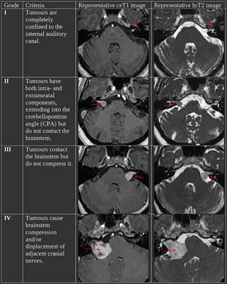 Automated Koos Classification of Vestibular Schwannoma
